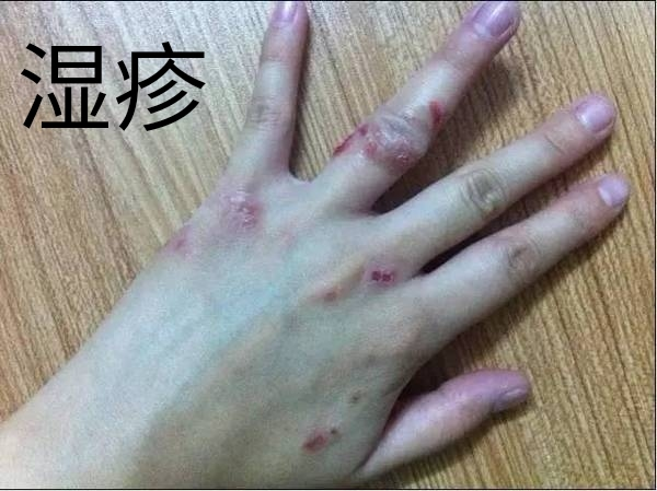 皮肤明显变薄,脆弱,萎缩,毛细血管扩张,紫癜,真菌感染,痤疮样皮炎等等