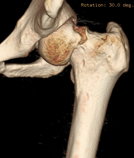 骨伤二科利用daa入路fns治疗青年难复型股骨颈骨折